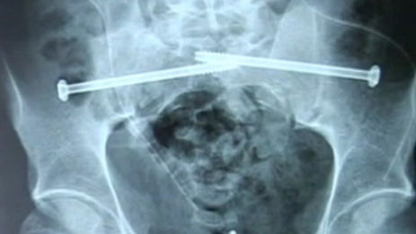 Racer returns after dislocating spine