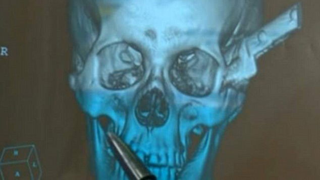 Brazilian man rides motorcycle 60 miles to hospital with knife in his head