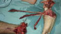 Surgeons re-attach biker's foot