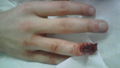 Picture exclusive: Jonny Rea's mangled finger