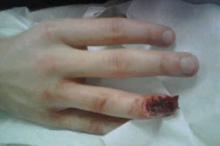 Picture exclusive: Jonny Rea's mangled finger