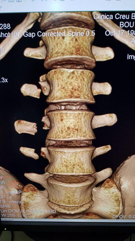 Toni Bou vertebrae