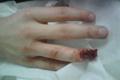 Picture exclusive: Jonny Rea's mangled finger