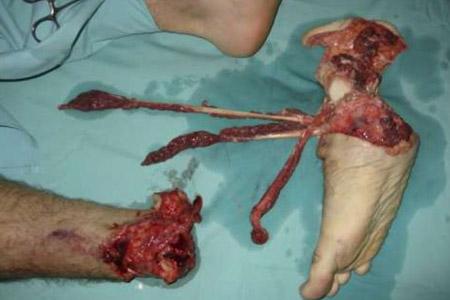 Surgeons re-attach biker's foot