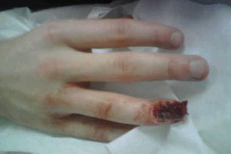 Picture exclusive: Jonny Rea's mangled finger